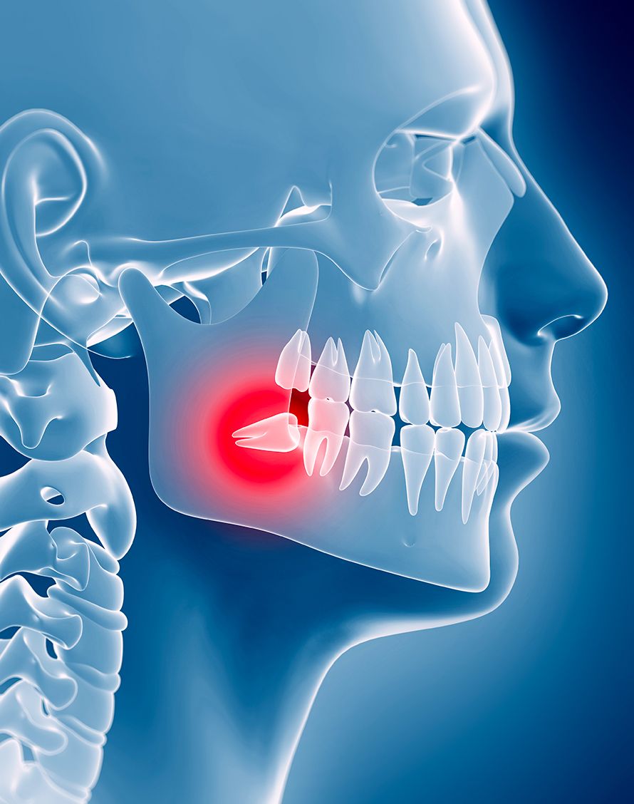 Extraction des dents de sagesse, Anesthésies et tarifs, Dr Chardain